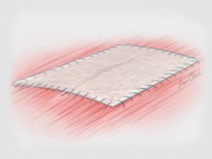 Biodesign 4-Layer Tissue Graft